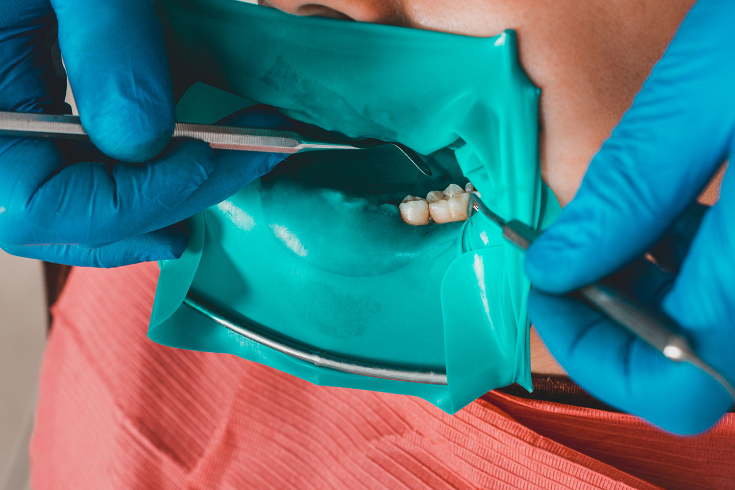 ラバーダム防湿の様子